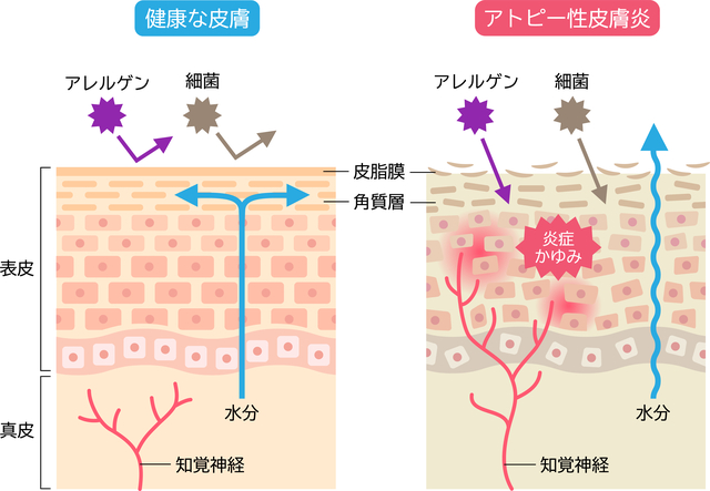 アトピー性皮膚炎