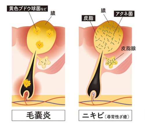 ニキビ